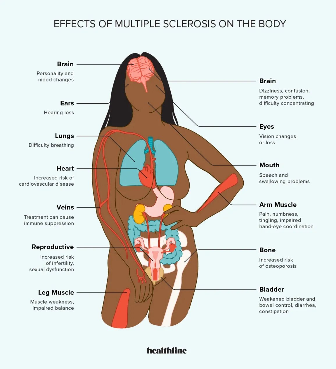 Multiple Sclerosis